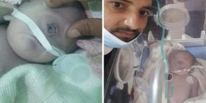 Kondisi Bayi Mata Satu. Foto Gulf News.